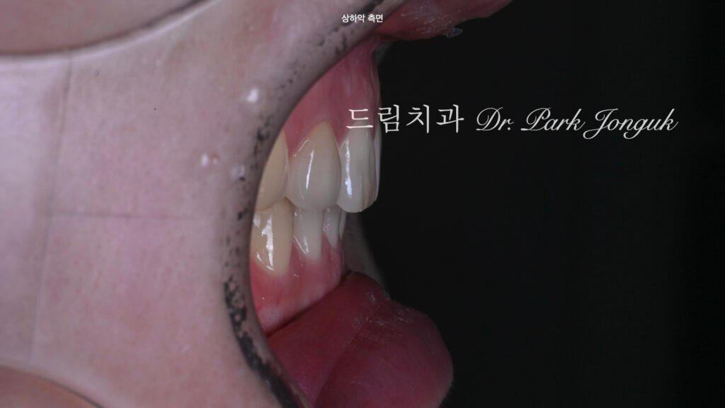 무삭제 라미네이트, 올세라믹 크라운 재시술 동시에