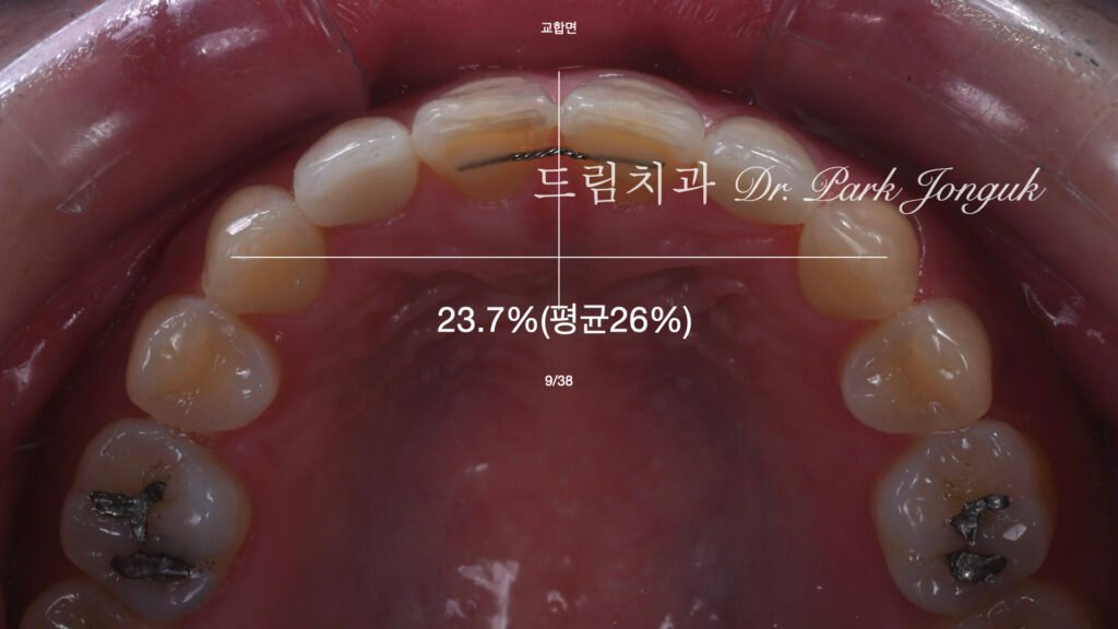 무삭제 라미네이트, 올세라믹 크라운 재시술 동시에