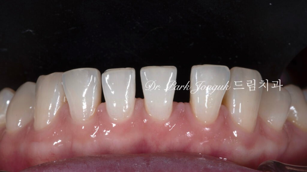 라미네이트, 무삭제 라미네이트, 치아사이공간, 벌어진치아 라미네이트, diastema, gap teeth, laminate veneer, no-prep veneer, 앞니 라미네이트, 자연스러운 라미네이트, 심미치과, 세라믹 라미네이트, feldspathic veneer, 강남 라미네이트, Dream Dental Clinic, cosmetic dentistry