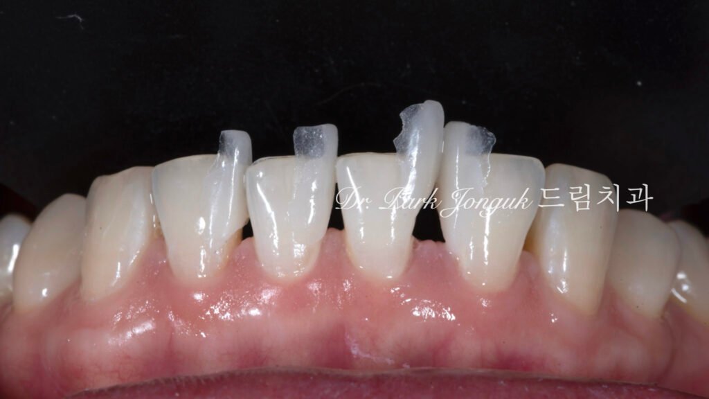 라미네이트, 무삭제 라미네이트, 치아사이공간, 벌어진치아 라미네이트, diastema, gap teeth, laminate veneer, no-prep veneer, 앞니 라미네이트, 자연스러운 라미네이트, 심미치과, 세라믹 라미네이트, feldspathic veneer, 강남 라미네이트, Dream Dental Clinic, cosmetic dentistry