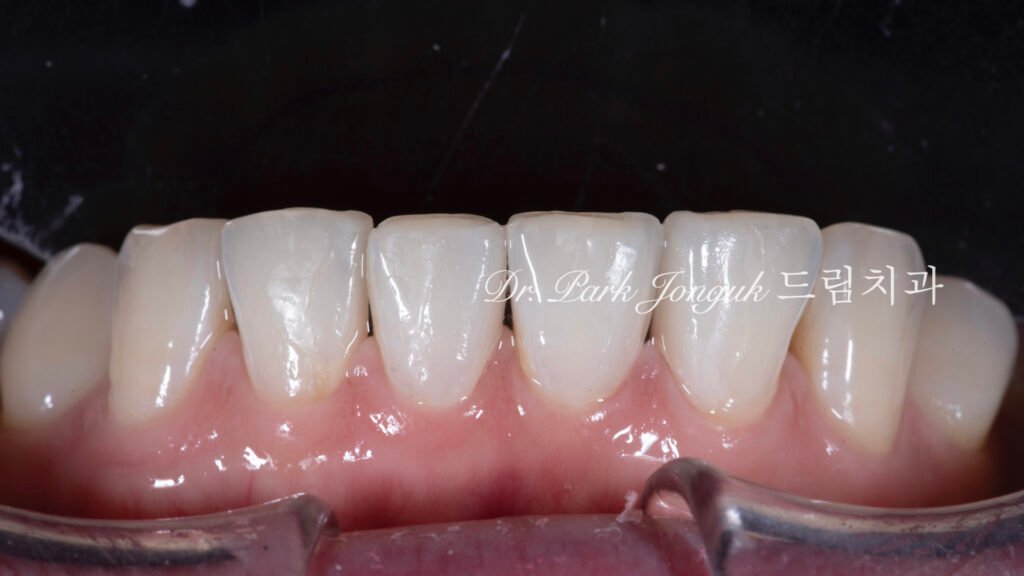 라미네이트, 무삭제 라미네이트, 치아사이공간, 벌어진치아 라미네이트, diastema, gap teeth, laminate veneer, no-prep veneer, 앞니 라미네이트, 자연스러운 라미네이트, 심미치과, 세라믹 라미네이트, feldspathic veneer, 강남 라미네이트, Dream Dental Clinic, cosmetic dentistry