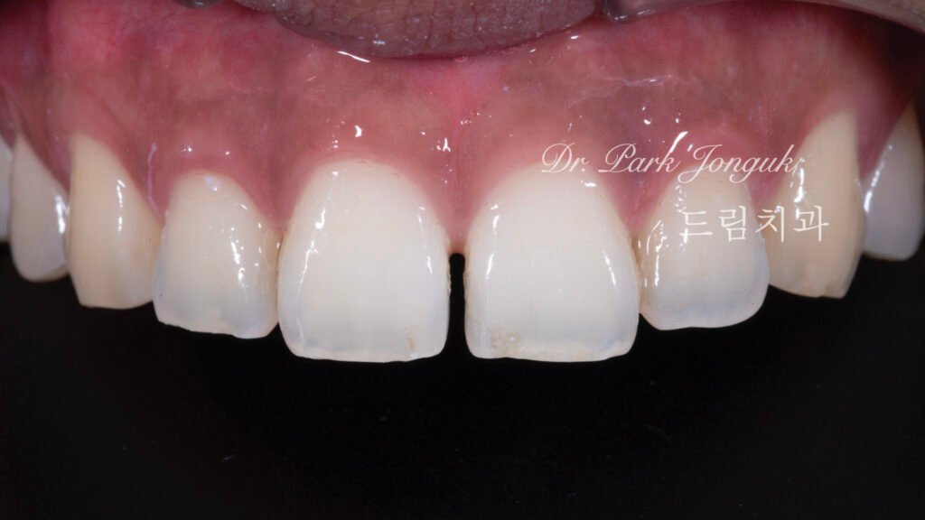 라미네이트, 무삭제 라미네이트, 치아사이공간, 벌어진치아 라미네이트, diastema, gap teeth, laminate veneer, no-prep veneer, 앞니 라미네이트, 자연스러운 라미네이트, 심미치과, 세라믹 라미네이트, feldspathic veneer, 강남 라미네이트, Dream Dental Clinic, cosmetic dentistry