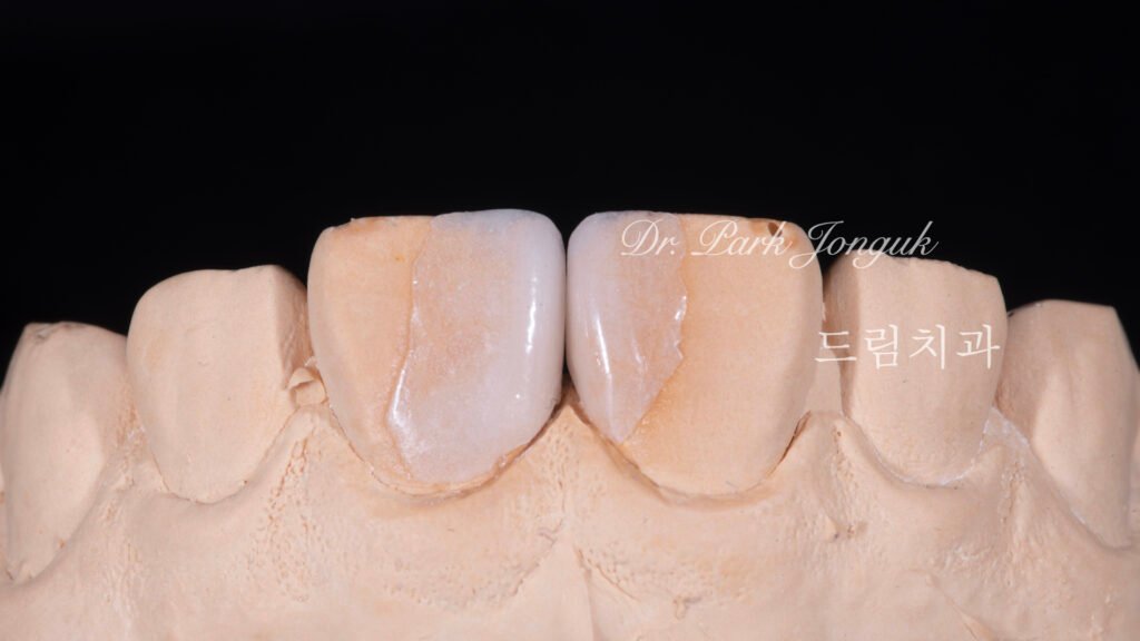 라미네이트, 무삭제 라미네이트, 치아사이공간, 벌어진치아 라미네이트, diastema, gap teeth, laminate veneer, no-prep veneer, 앞니 라미네이트, 자연스러운 라미네이트, 심미치과, 세라믹 라미네이트, feldspathic veneer, 강남 라미네이트, Dream Dental Clinic, cosmetic dentistry