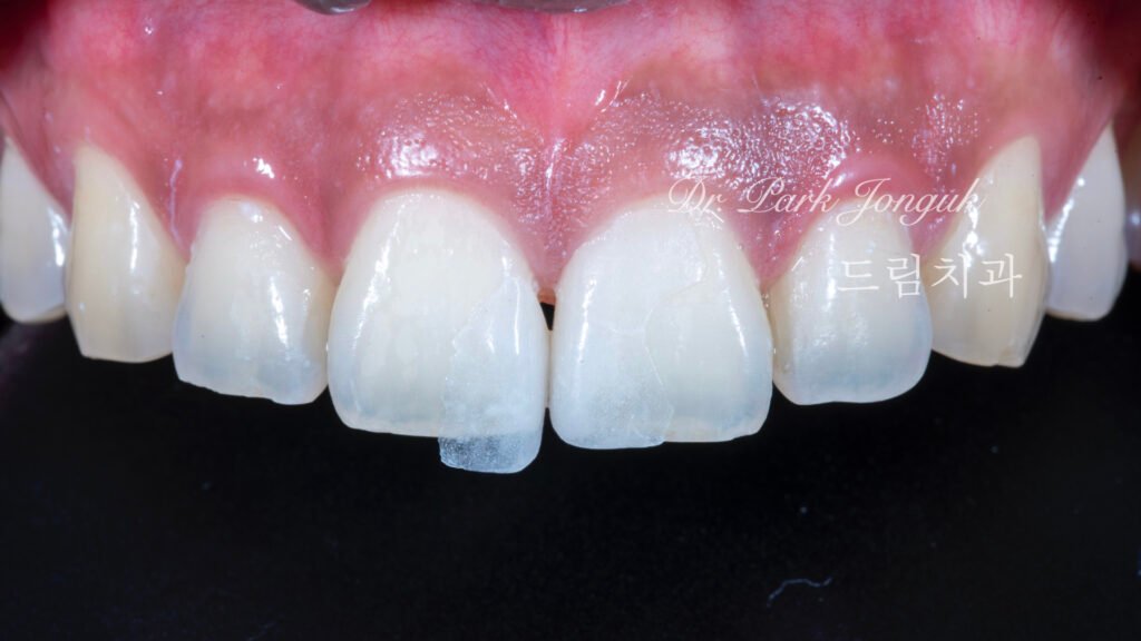 라미네이트, 무삭제 라미네이트, 치아사이공간, 벌어진치아 라미네이트, diastema, gap teeth, laminate veneer, no-prep veneer, 앞니 라미네이트, 자연스러운 라미네이트, 심미치과, 세라믹 라미네이트, feldspathic veneer, 강남 라미네이트, Dream Dental Clinic, cosmetic dentistry