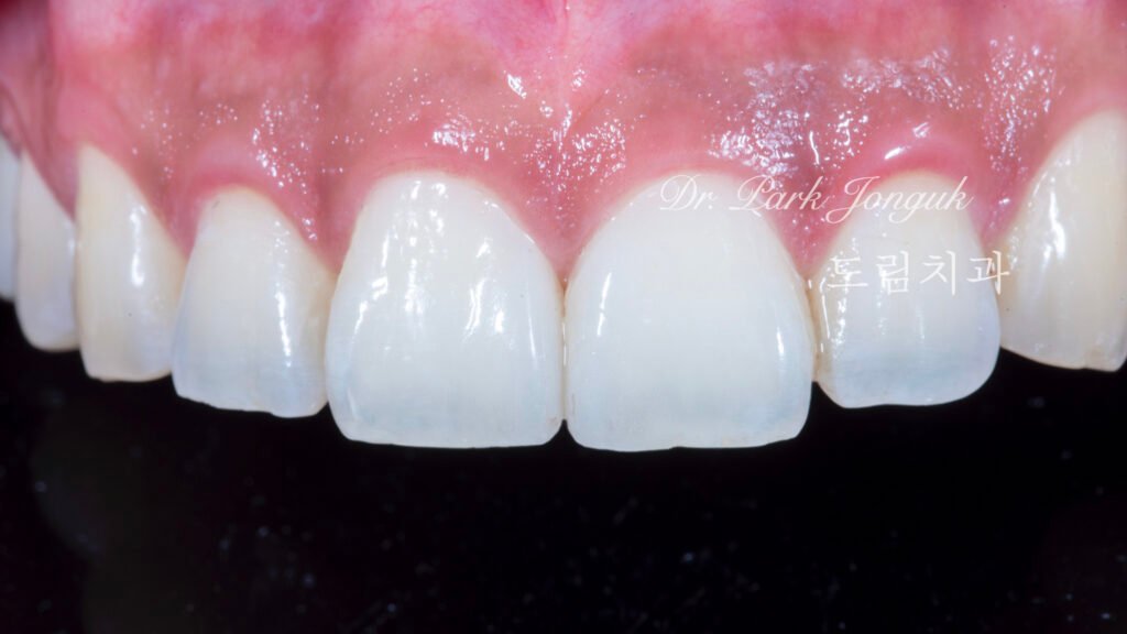 라미네이트, 무삭제 라미네이트, 치아사이공간, 벌어진치아 라미네이트, diastema, gap teeth, laminate veneer, no-prep veneer, 앞니 라미네이트, 자연스러운 라미네이트, 심미치과, 세라믹 라미네이트, feldspathic veneer, 강남 라미네이트, Dream Dental Clinic, cosmetic dentistry