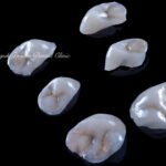 역류성 식도염 무삭제 샌드위치 테크닉 라미네이트