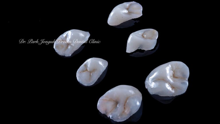 역류성 식도염 무삭제 샌드위치 테크닉 라미네이트