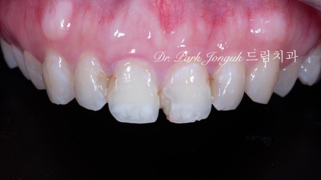 앞니충치, 앞니레진, 앞니라미네이트, 올세라믹크라운, laminate, ceramic crown, aesthetic dentistry, dental diagnosis, smile design