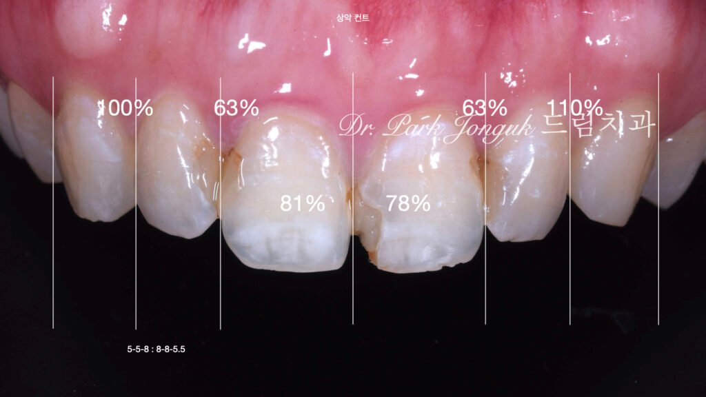 앞니충치, 앞니레진, 앞니라미네이트, 올세라믹크라운, laminate, ceramic crown, aesthetic dentistry, dental diagnosis, smile design
