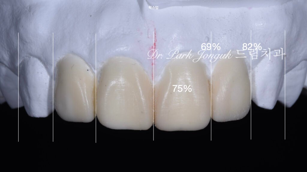 앞니충치, 앞니레진, 앞니라미네이트, 올세라믹크라운, laminate, ceramic crown, aesthetic dentistry, dental diagnosis, smile design