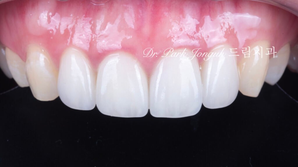 앞니충치, 앞니레진, 앞니라미네이트, 올세라믹크라운, laminate, ceramic crown, aesthetic dentistry, dental diagnosis, smile design