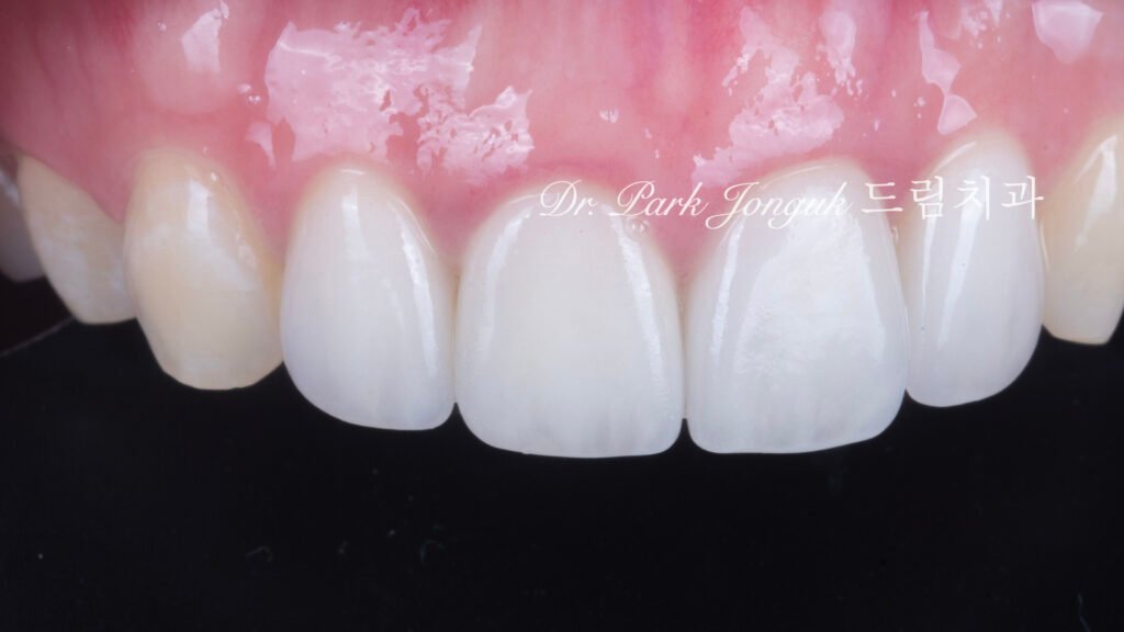앞니충치, 앞니레진, 앞니라미네이트, 올세라믹크라운, laminate, ceramic crown, aesthetic dentistry, dental diagnosis, smile design