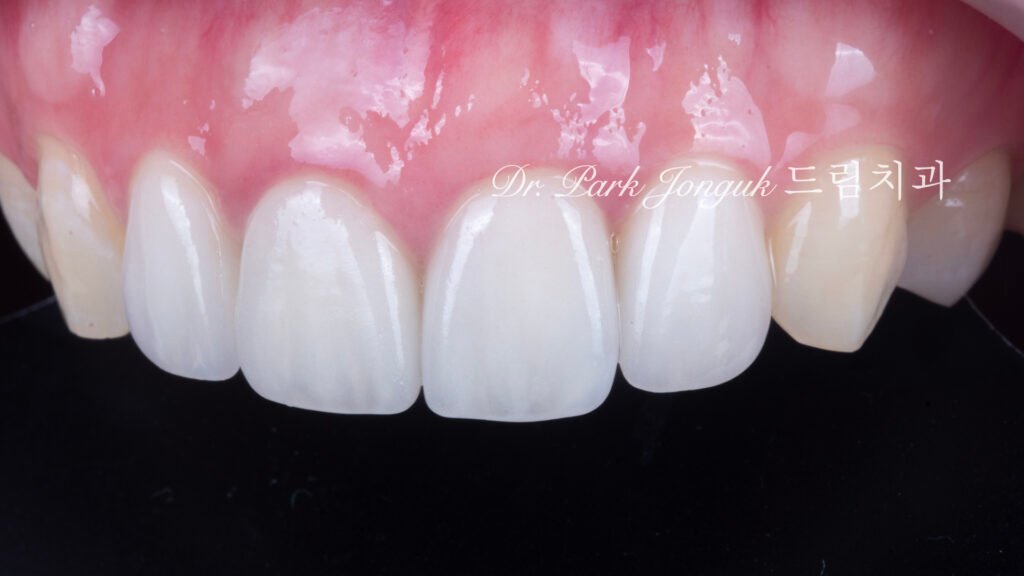 앞니충치, 앞니레진, 앞니라미네이트, 올세라믹크라운, laminate, ceramic crown, aesthetic dentistry, dental diagnosis, smile design