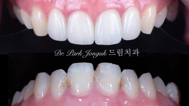 앞니충치, 앞니레진, 앞니라미네이트, 올세라믹크라운, laminate, ceramic crown, aesthetic dentistry, dental diagnosis, smile design