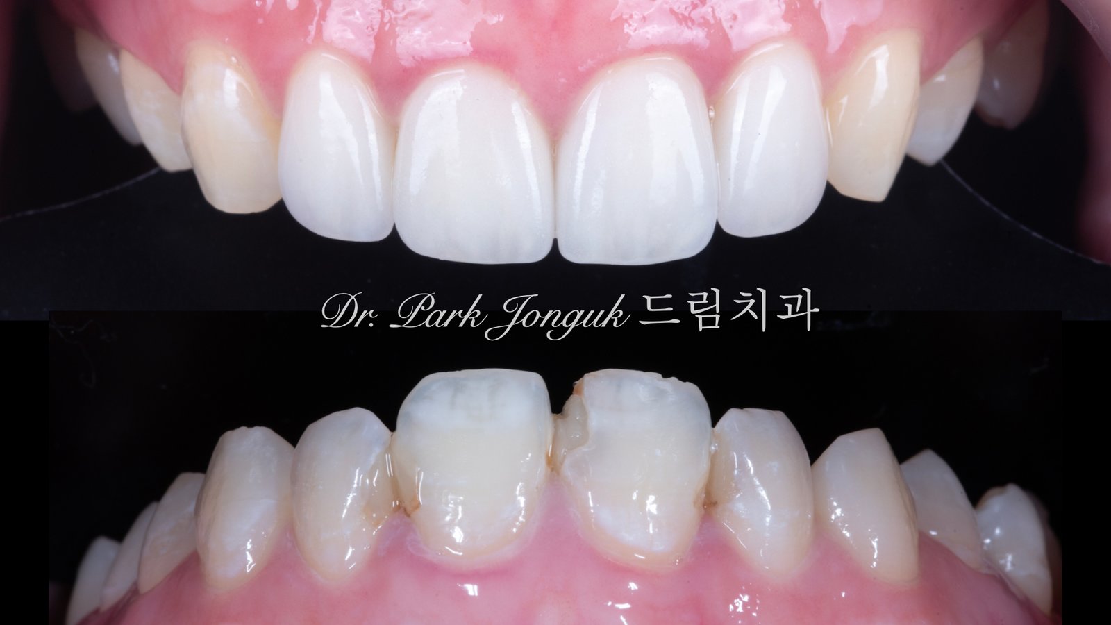 앞니충치, 앞니레진, 앞니라미네이트, 올세라믹크라운, laminate, ceramic crown, aesthetic dentistry, dental diagnosis, smile design