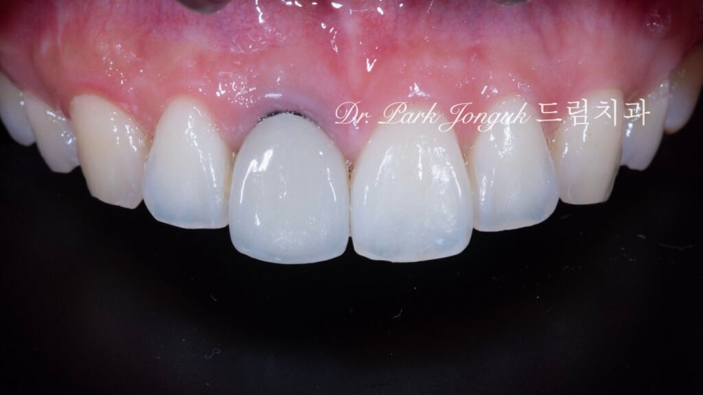 앞니 올세라믹 크라운, Anterior All-Ceramic Crown, 올세라믹 크라운 변색, All-Ceramic Crown Discoloration, 앞니 변색