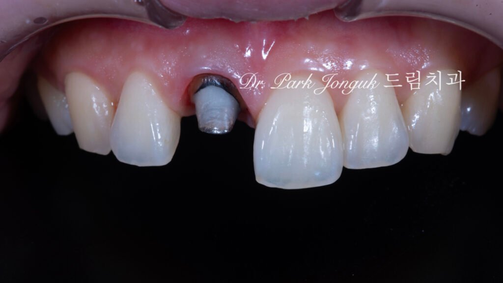앞니 올세라믹 크라운, Anterior All-Ceramic Crown, 올세라믹 크라운 변색, All-Ceramic Crown Discoloration, 앞니 변색