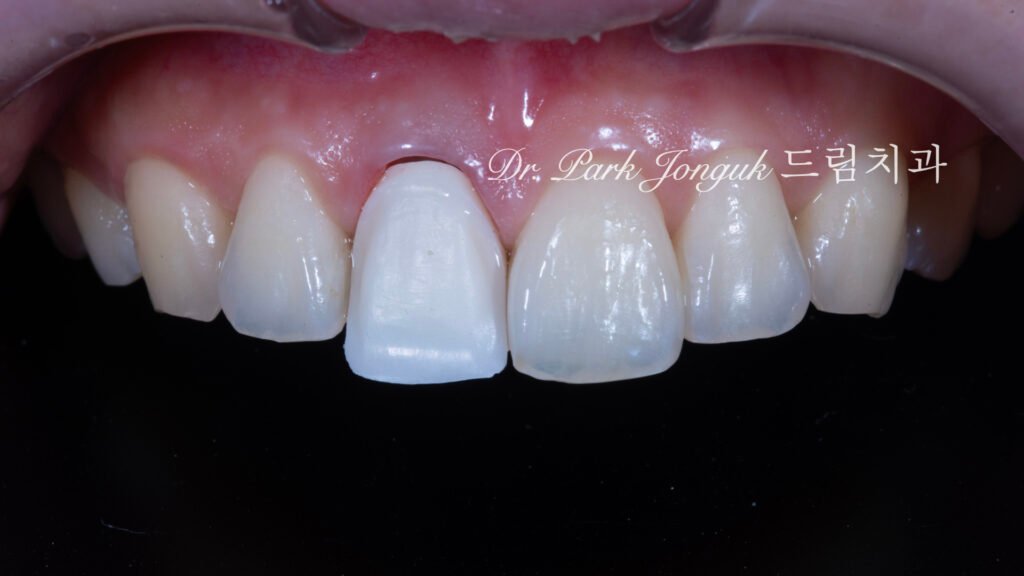 앞니 올세라믹 크라운, Anterior All-Ceramic Crown, 올세라믹 크라운 변색, All-Ceramic Crown Discoloration, 앞니 변색
