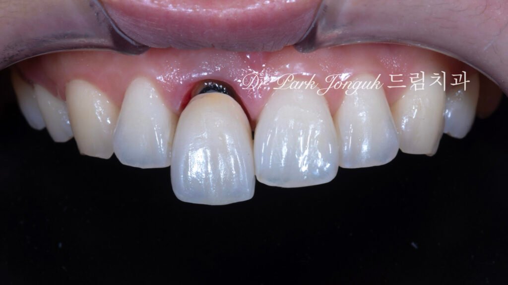 앞니 올세라믹 크라운, Anterior All-Ceramic Crown, 올세라믹 크라운 변색, All-Ceramic Crown Discoloration, 앞니 변색