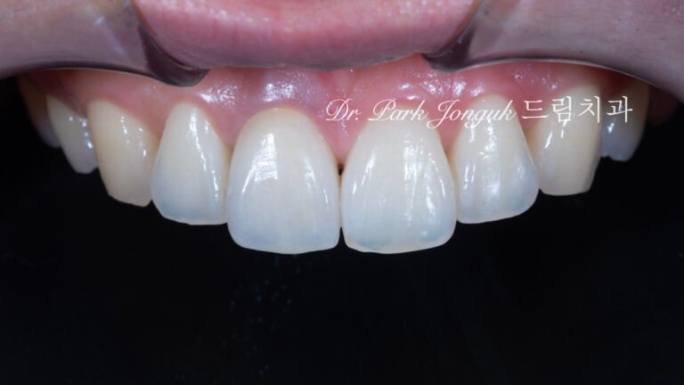 앞니 올세라믹 크라운, Anterior All-Ceramic Crown, 올세라믹 크라운 변색, All-Ceramic Crown Discoloration, 앞니 변색, Anterior Tooth Discoloration, 올세라믹 크라운 재치료, All-Ceramic Crown Revision, 지르코니아 베이스, Zirconia Base