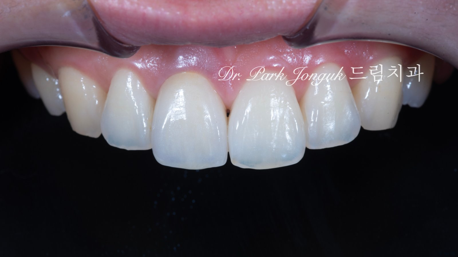 앞니 올세라믹 크라운, Anterior All-Ceramic Crown, 올세라믹 크라운 변색, All-Ceramic Crown Discoloration, 앞니 변색, Anterior Tooth Discoloration, 올세라믹 크라운 재치료, All-Ceramic Crown Revision, 지르코니아 베이스, Zirconia Base