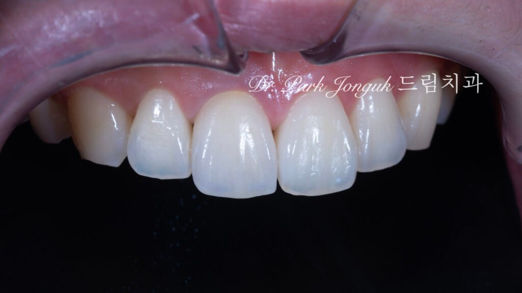 앞니 올세라믹 크라운, Anterior All-Ceramic Crown, 올세라믹 크라운 변색, All-Ceramic Crown Discoloration, 앞니 변색