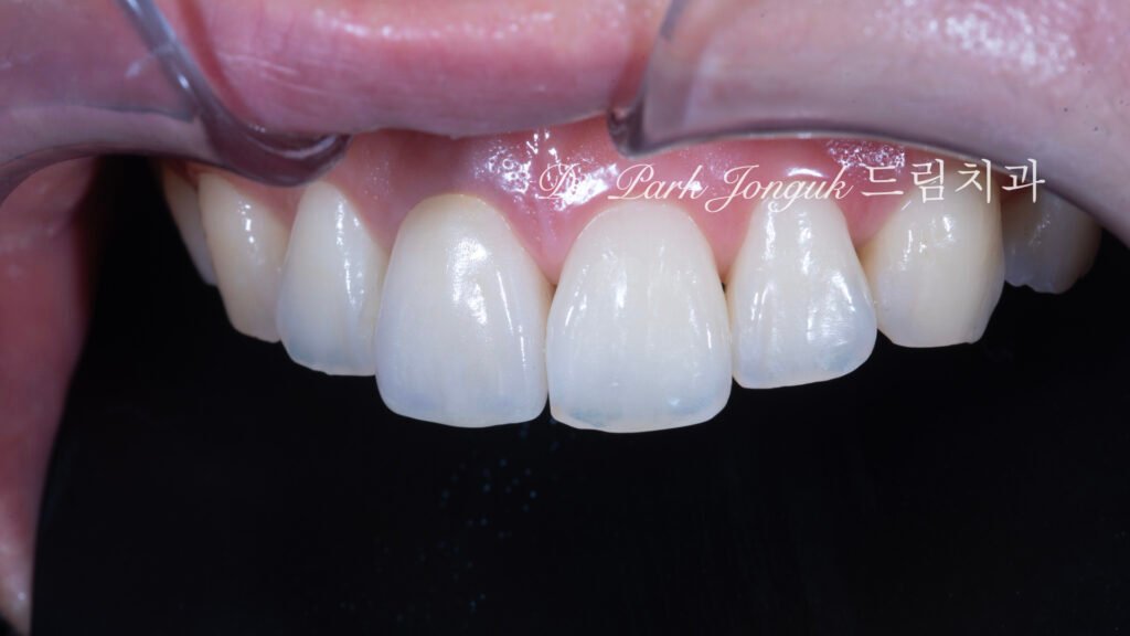 앞니 올세라믹 크라운, Anterior All-Ceramic Crown, 올세라믹 크라운 변색, All-Ceramic Crown Discoloration, 앞니 변색