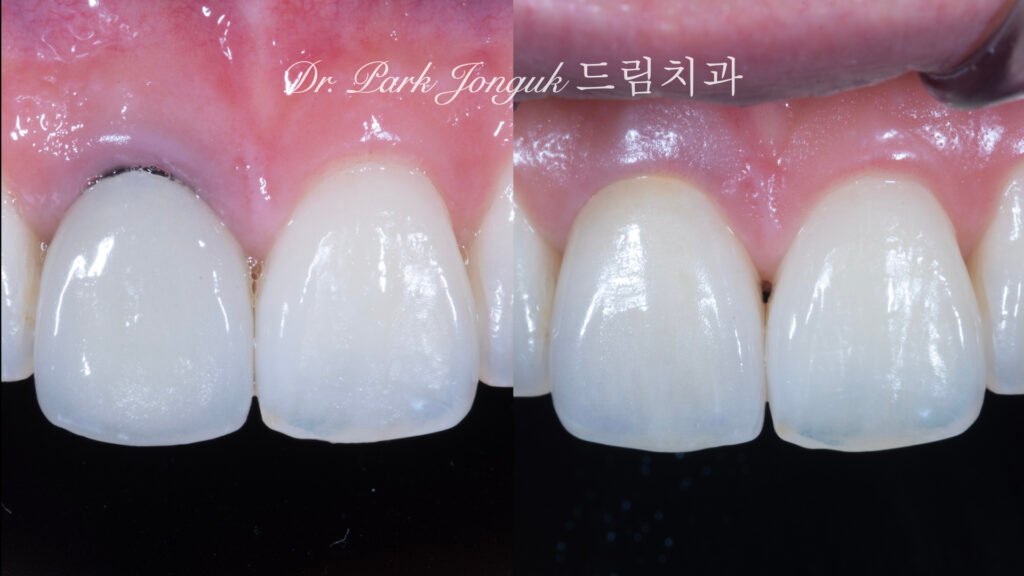 앞니 올세라믹 크라운, Anterior All-Ceramic Crown, 올세라믹 크라운 변색, All-Ceramic Crown Discoloration, 앞니 변색