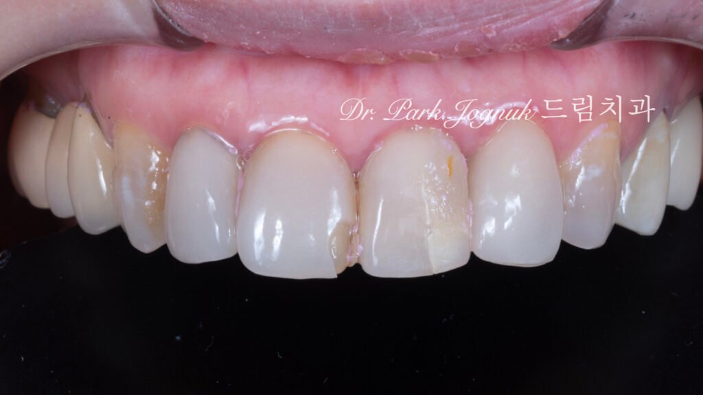 올세라믹 크라운 재시술 강남 라미네이트 자하는 곳