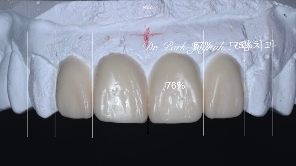 올세라믹 크라운 재시술 강남 라미네이트 자하는 곳