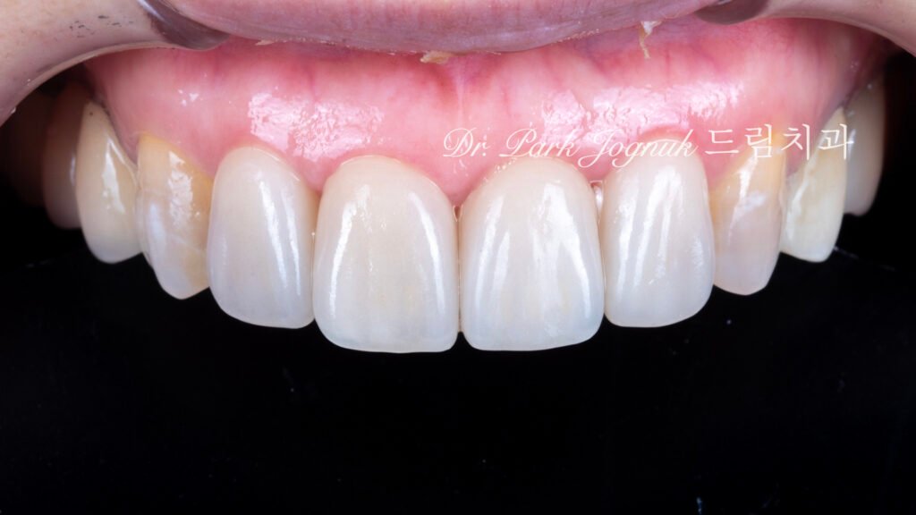 올세라믹 크라운 재시술 강남 라미네이트 자하는 곳
