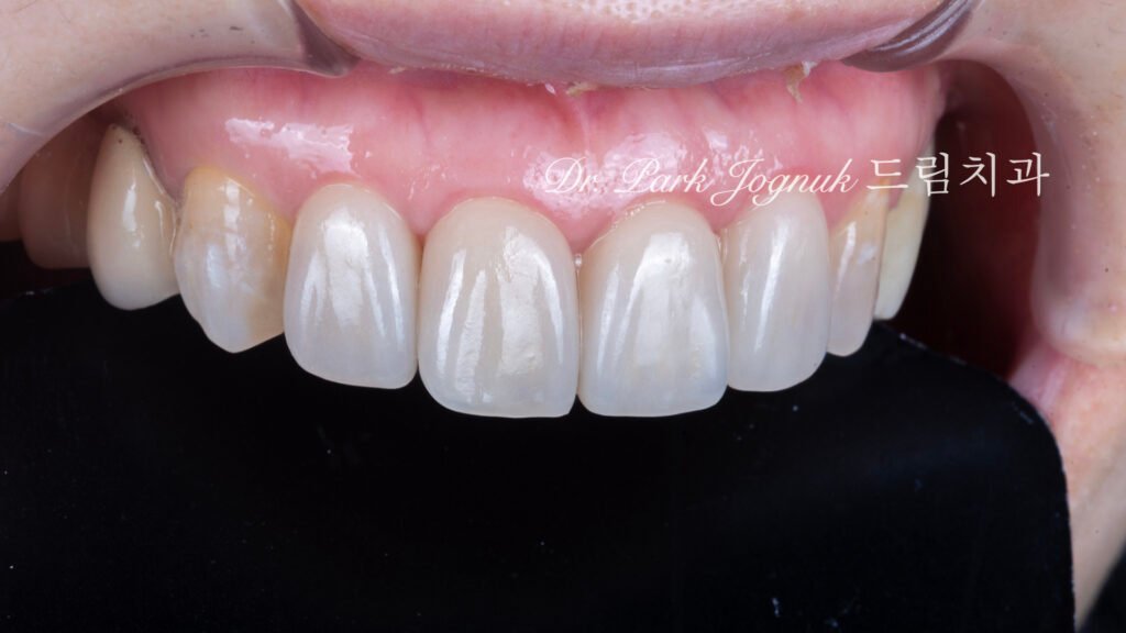 올세라믹 크라운 재시술 강남 라미네이트 자하는 곳