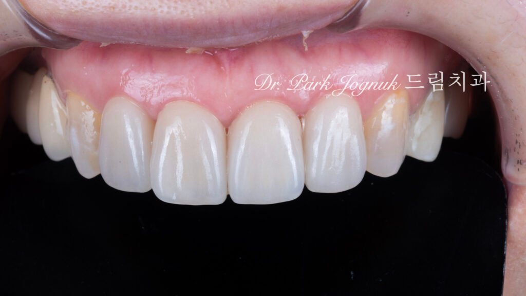 올세라믹 크라운 재시술 강남 라미네이트 자하는 곳