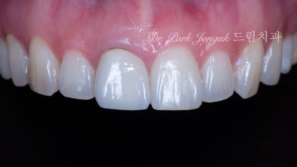 올세라믹 크라운 재시술, All-Ceramic Crown Revision, 라미네이트, Laminate Veneer, 색상 매칭, Color Matching, 광학적 특성, Optical Properties, 여성적 심미, Feminine Esthetics