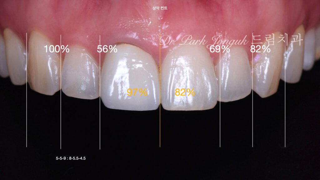 올세라믹 크라운 재시술, All-Ceramic Crown Revision, 라미네이트, Laminate Veneer, 색상 매칭, Color Matching, 광학적 특성, Optical Properties, 여성적 심미, Feminine Esthetics