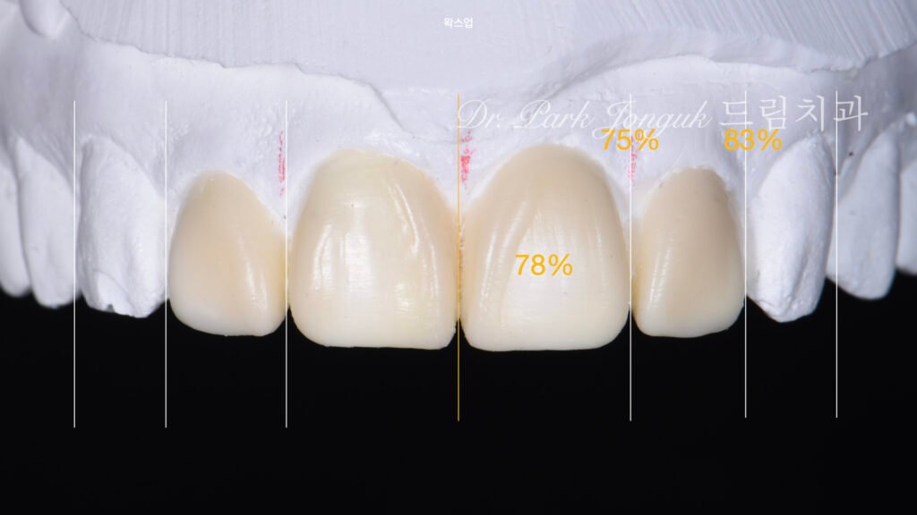 올세라믹 크라운 재시술, All-Ceramic Crown Revision, 라미네이트, Laminate Veneer, 색상 매칭, Color Matching, 광학적 특성, Optical Properties, 여성적 심미, Feminine Esthetics