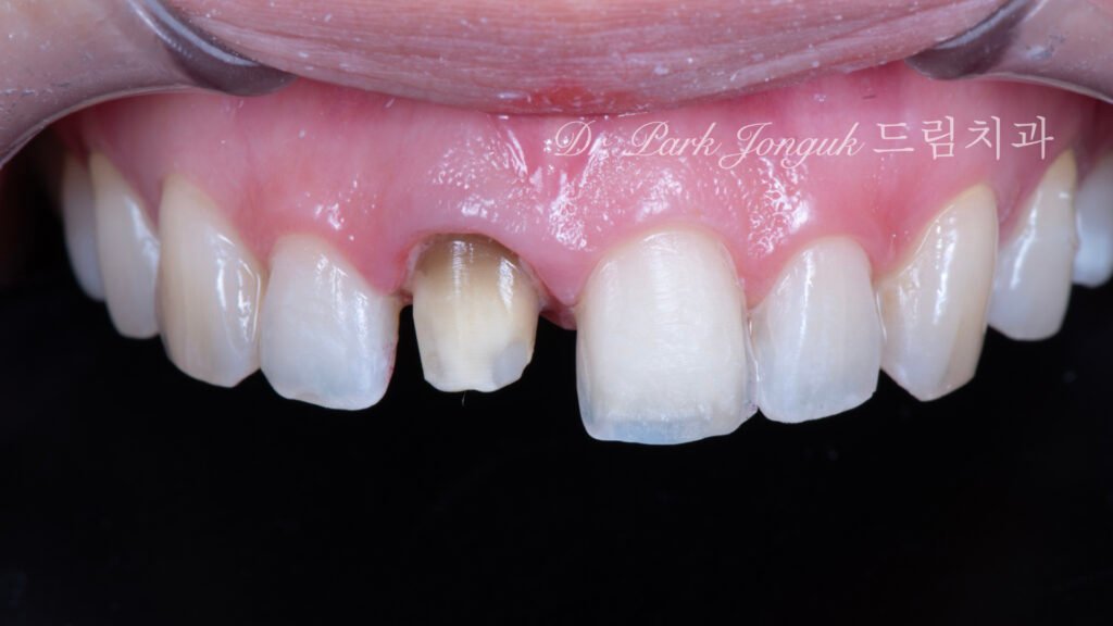올세라믹 크라운 재시술, All-Ceramic Crown Revision, 라미네이트, Laminate Veneer, 색상 매칭, Color Matching, 광학적 특성, Optical Properties, 여성적 심미, Feminine Esthetics