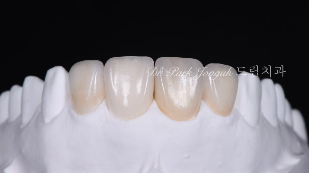 올세라믹 크라운 재시술, All-Ceramic Crown Revision, 라미네이트, Laminate Veneer, 색상 매칭, Color Matching, 광학적 특성, Optical Properties, 여성적 심미, Feminine Esthetics