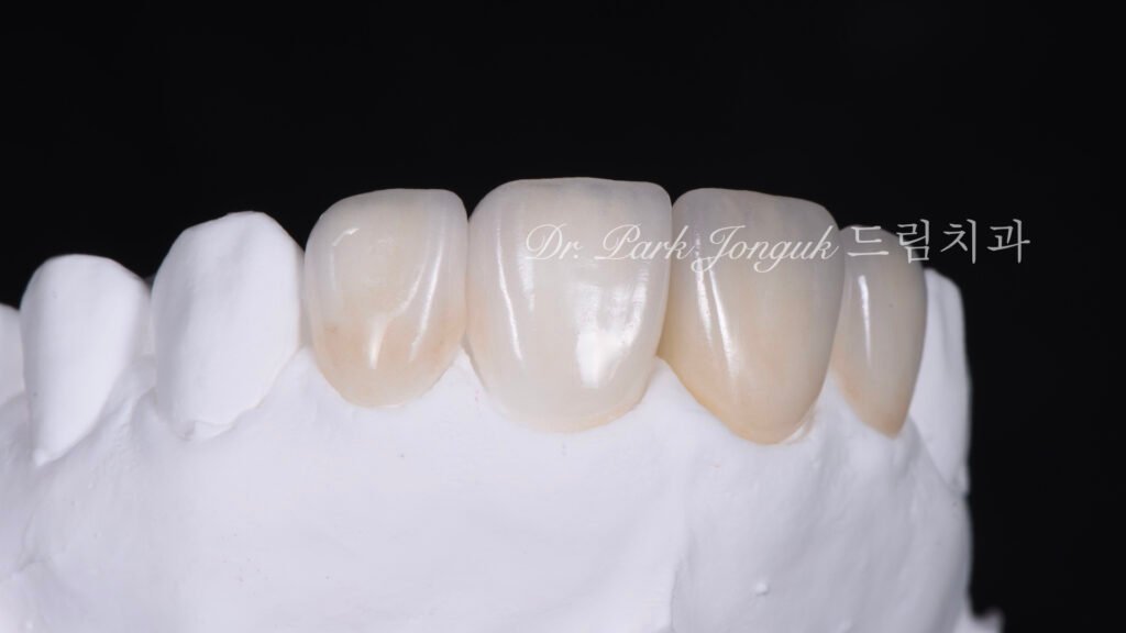 올세라믹 크라운 재시술, All-Ceramic Crown Revision, 라미네이트, Laminate Veneer, 색상 매칭, Color Matching, 광학적 특성, Optical Properties, 여성적 심미, Feminine Esthetics