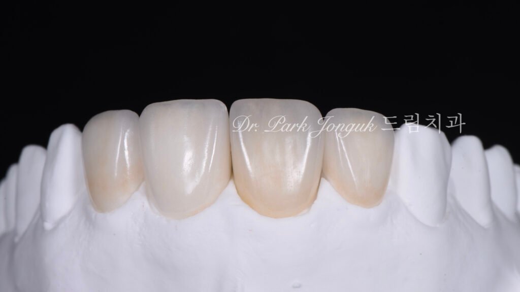 올세라믹 크라운 재시술, All-Ceramic Crown Revision, 라미네이트, Laminate Veneer, 색상 매칭, Color Matching, 광학적 특성, Optical Properties, 여성적 심미, Feminine Esthetics
