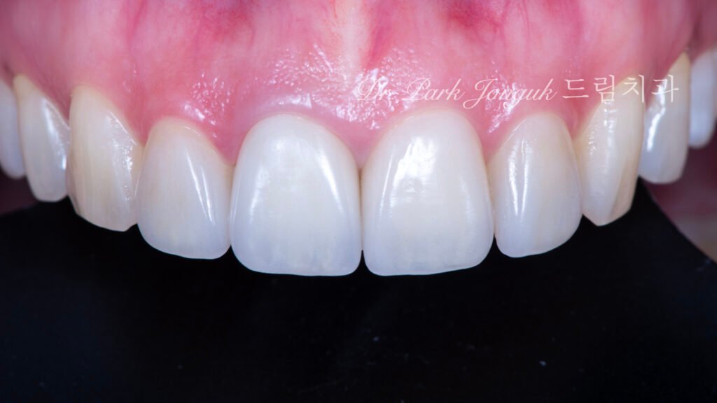 올세라믹 크라운 재시술, All-Ceramic Crown Revision, 라미네이트, Laminate Veneer, 색상 매칭, Color Matching, 광학적 특성, Optical Properties, 여성적 심미, Feminine Esthetics