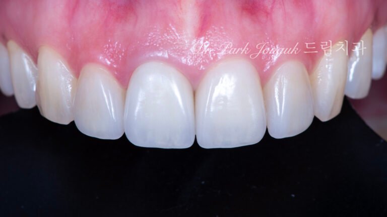 올세라믹 크라운 재시술, All-Ceramic Crown Revision, 라미네이트, Laminate Veneer, 색상 매칭, Color Matching, 광학적 특성, Optical Properties, 여성적 심미, Feminine Esthetics