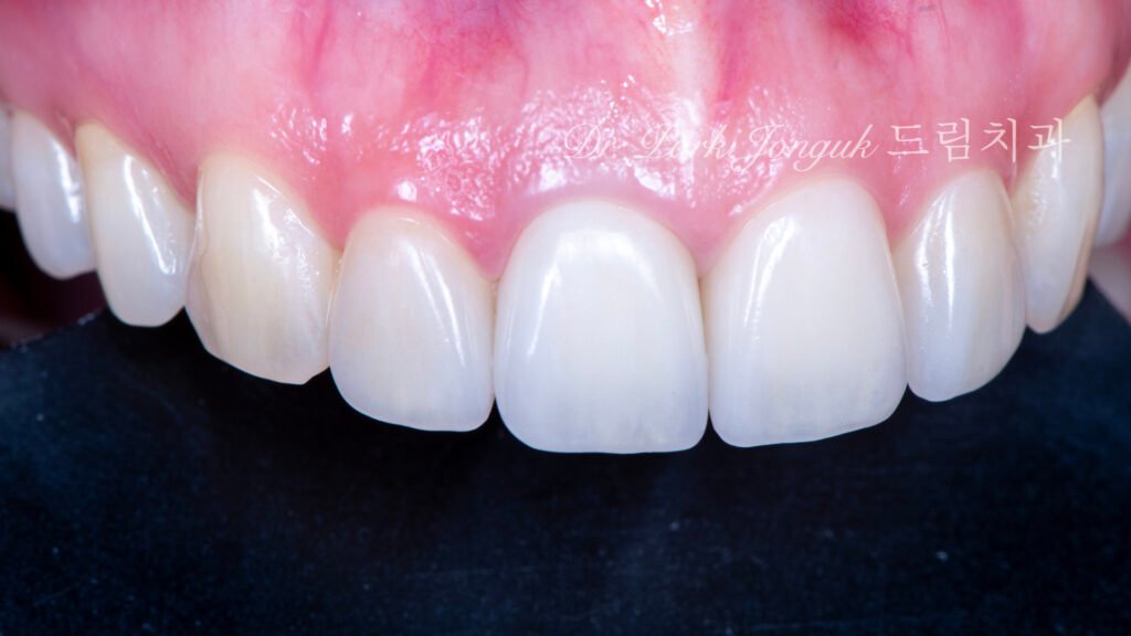 올세라믹 크라운 재시술, All-Ceramic Crown Revision, 라미네이트, Laminate Veneer, 색상 매칭, Color Matching, 광학적 특성, Optical Properties, 여성적 심미, Feminine Esthetics