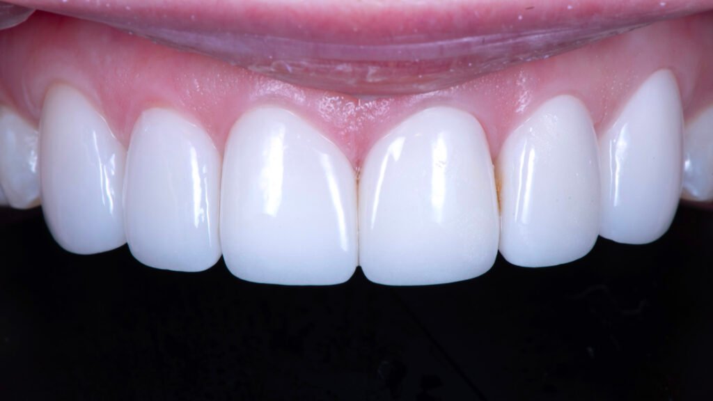 라미네이트 재시술, Laminate Revision, 불투명한 라미네이트, Opaque Laminate, 비자연적 백색, Unnatural Whiteness, 레이저 제거, Laser Removal, 수작업 빌드업, Hand-Layered Build-up