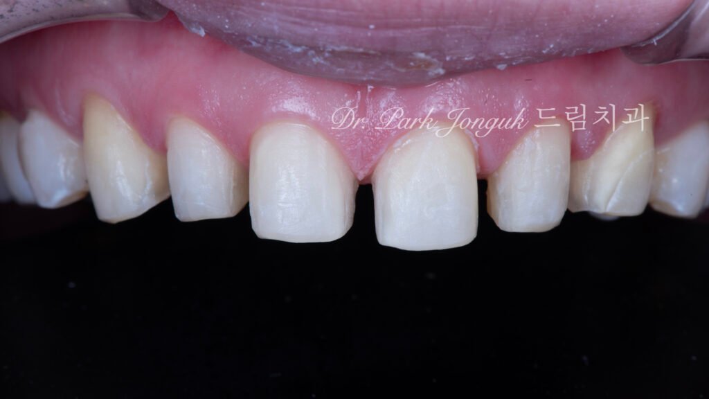 라미네이트 재시술, Laminate Revision, 불투명한 라미네이트, Opaque Laminate, 비자연적 백색, Unnatural Whiteness, 레이저 제거, Laser Removal, 수작업 빌드업, Hand-Layered Build-up