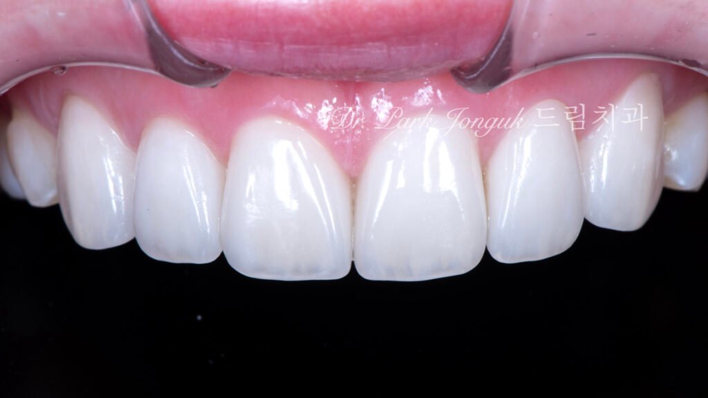 라미네이트 재시술, Laminate Revision, 불투명한 라미네이트, Opaque Laminate, 비자연적 백색, Unnatural Whiteness, 레이저 제거, Laser Removal, 수작업 빌드업, Hand-Layered Build-up