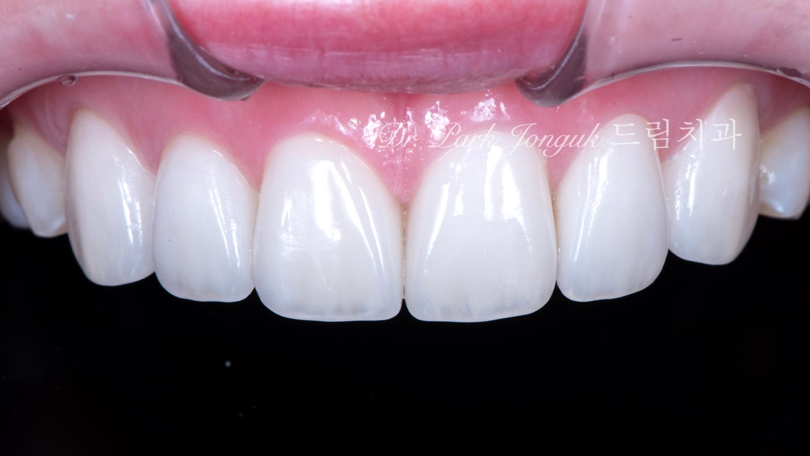 라미네이트 재시술, Laminate Revision, 불투명한 라미네이트, Opaque Laminate, 비자연적 백색, Unnatural Whiteness, 레이저 제거, Laser Removal, 수작업 빌드업, Hand-Layered Build-up