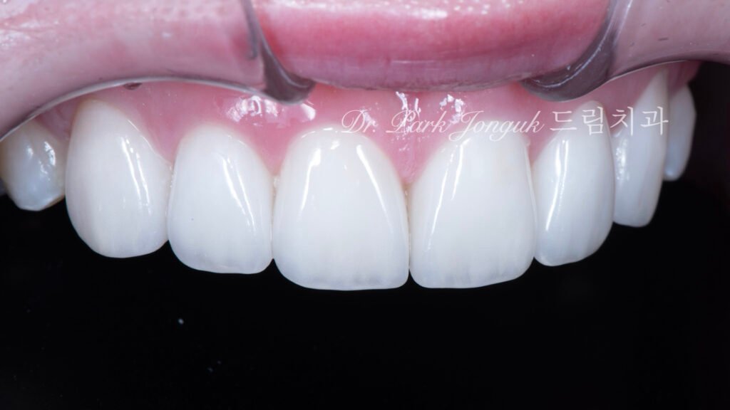 라미네이트 재시술, Laminate Revision, 불투명한 라미네이트, Opaque Laminate, 비자연적 백색, Unnatural Whiteness, 레이저 제거, Laser Removal, 수작업 빌드업, Hand-Layered Build-up