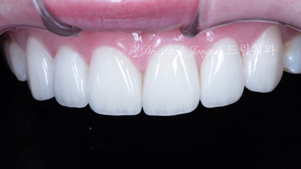 라미네이트 재시술, Laminate Revision, 불투명한 라미네이트, Opaque Laminate, 비자연적 백색, Unnatural Whiteness, 레이저 제거, Laser Removal, 수작업 빌드업, Hand-Layered Build-up