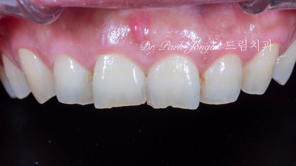 50대라미네이트, 치아노화라미네이트, 치아마모라미네이트, AgingTeeth, LaminateVeneers, ToothWear, 심미치과, 앞니라미네이트, 자연스러운라미네이트, 동안치아